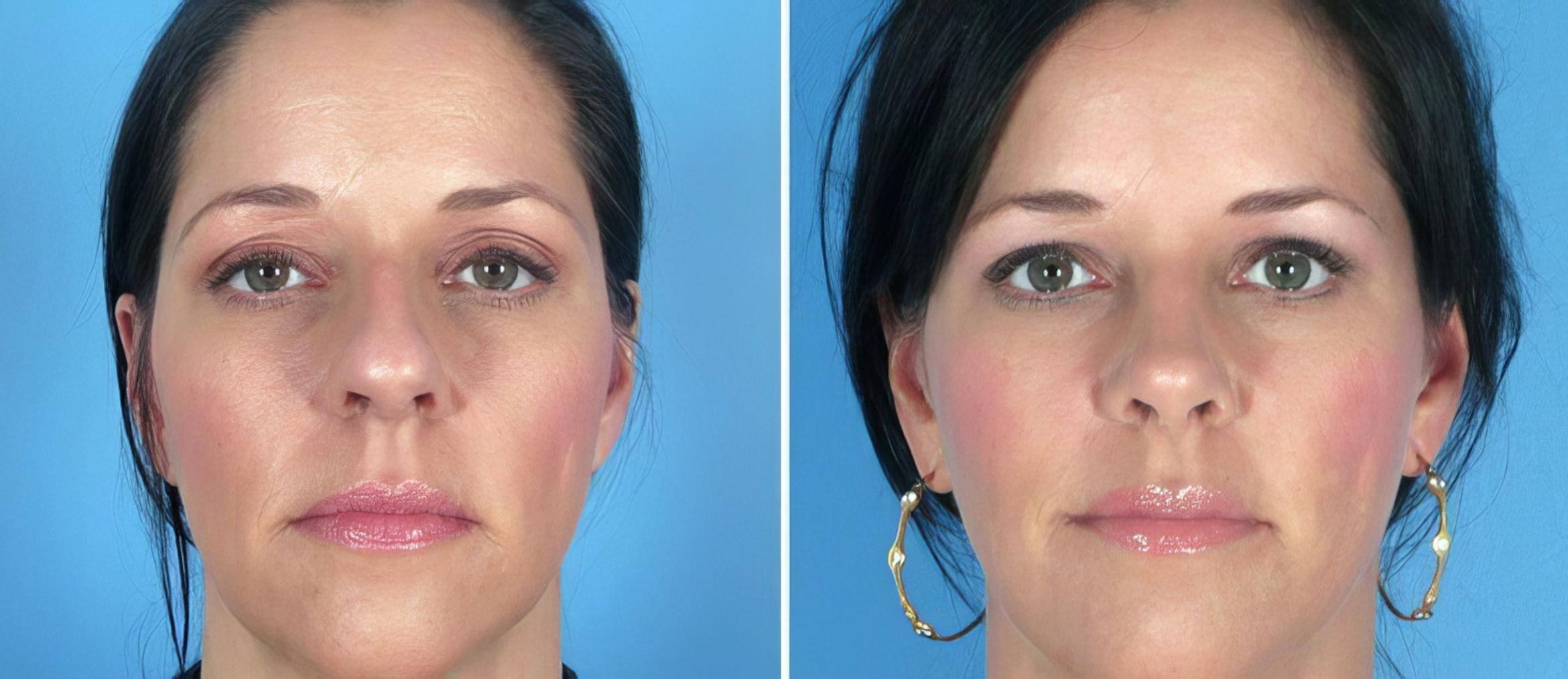 Rhinoplasty Before & After Case 25818