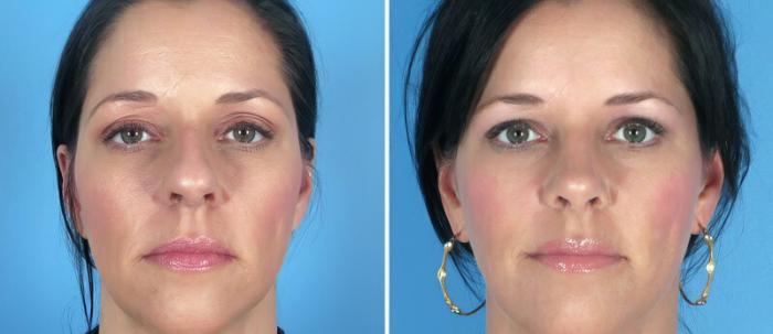 Rhinoplasty Before & After Case 25818