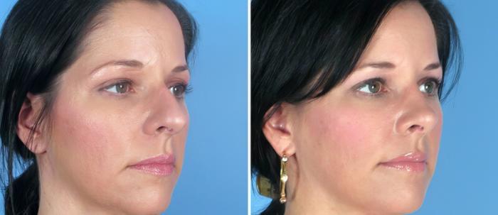 Rhinoplasty Before & After Case 25818