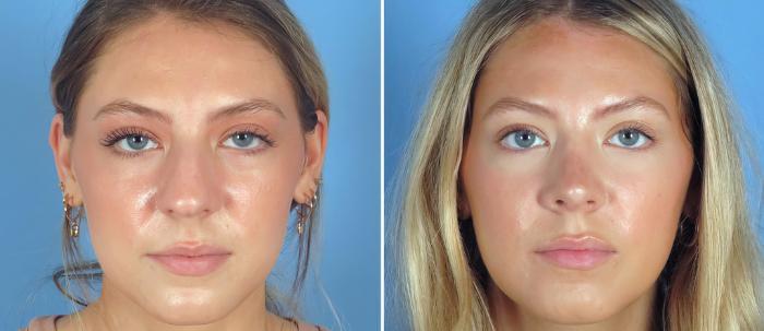 Rhinoplasty Before & After Case 26837