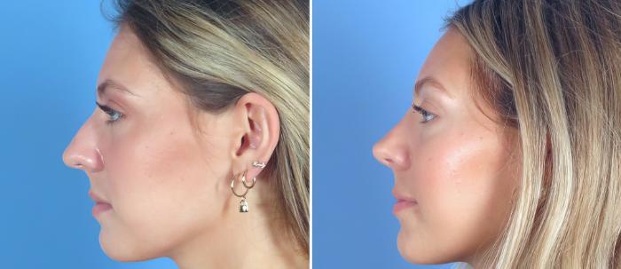 Rhinoplasty Before & After Case 26837