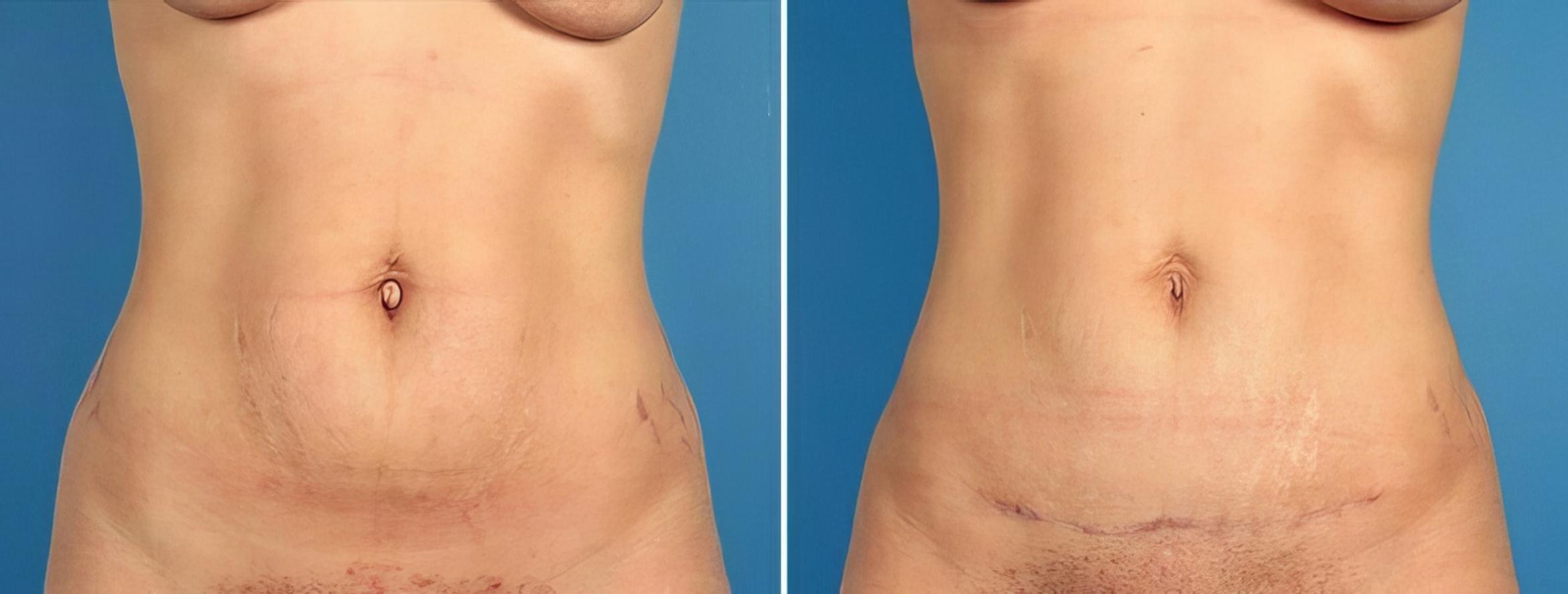 Tummy Tuck Before & After Case 16937