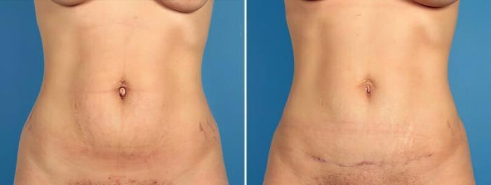 Tummy Tuck Before & After Case 16937