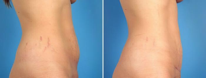 Tummy Tuck Before & After Case 16937
