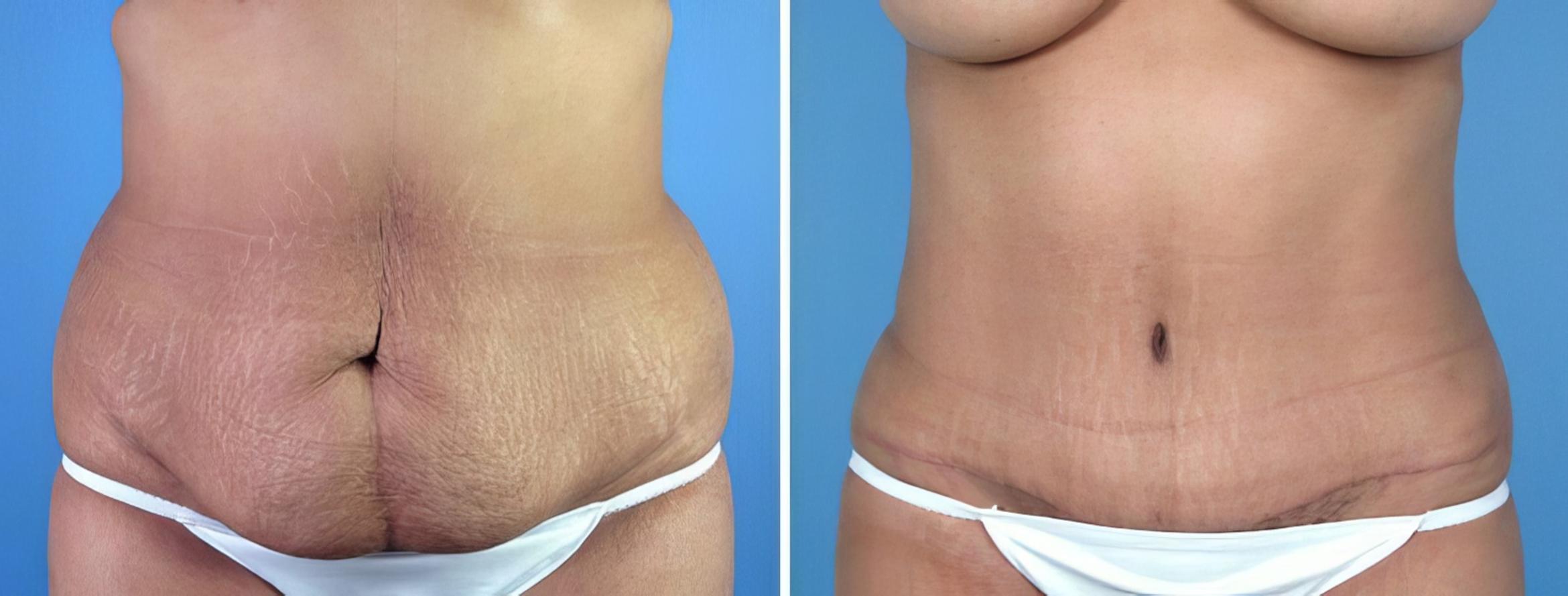 Tummy Tuck Before & After Case 16961