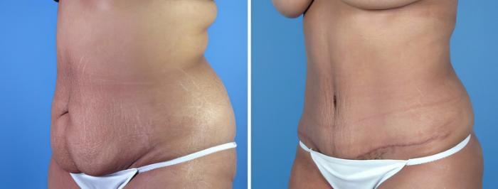 Tummy Tuck Before & After Case 16961