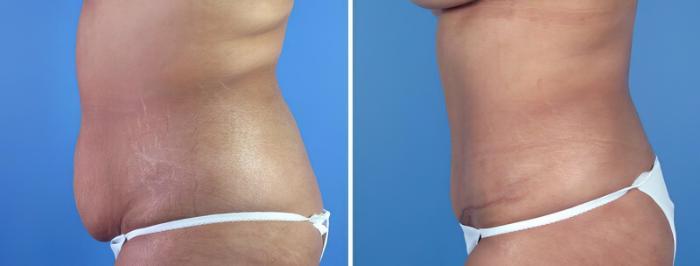 Tummy Tuck Before & After Case 16961