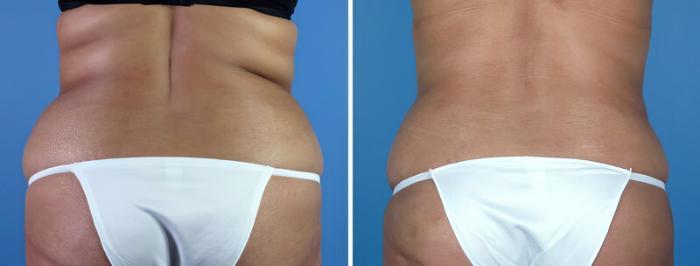 Tummy Tuck Before & After Case 16961