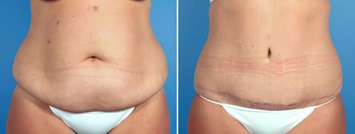 Tummy Tuck Before & After Case 16966