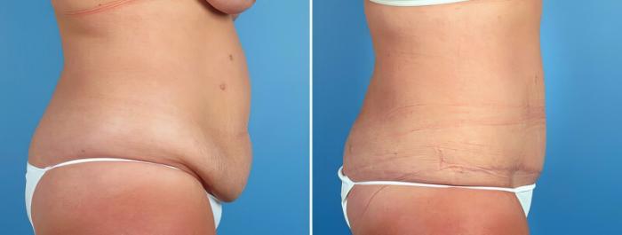 Tummy Tuck Before & After Case 16966