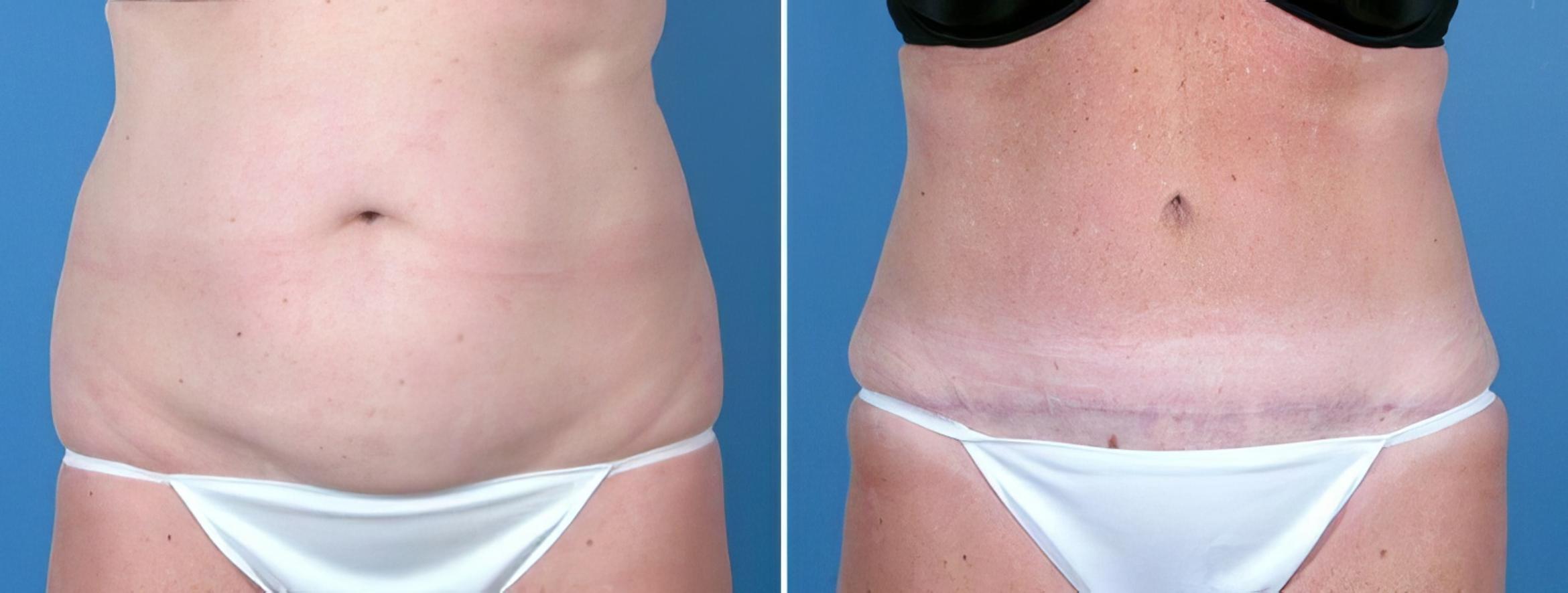 Tummy Tuck Before & After Case 16972