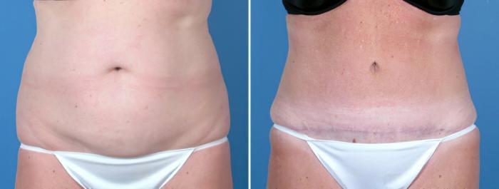 Tummy Tuck Before & After Case 16972