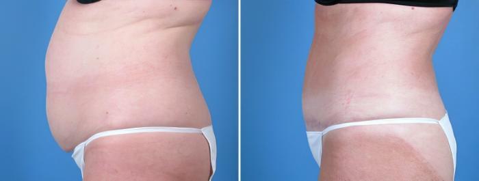 Tummy Tuck Before & After Case 16972