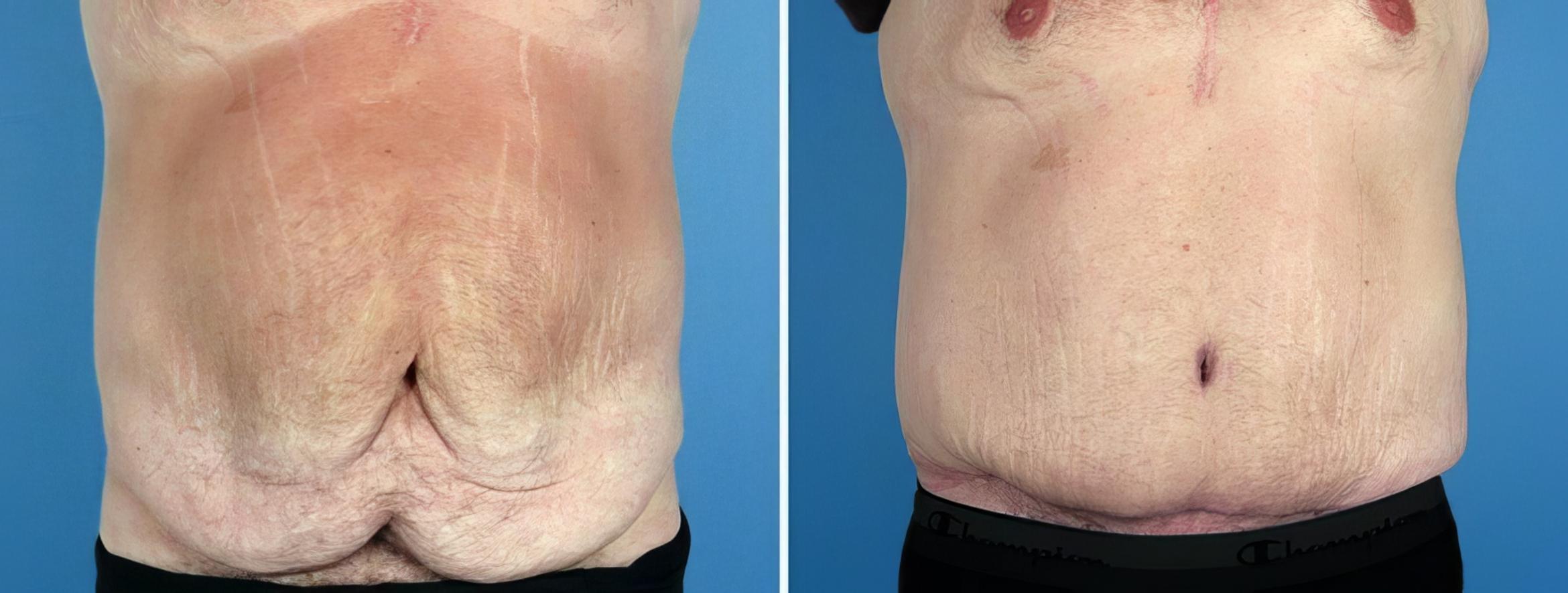 Tummy Tuck Before & After Case 17508