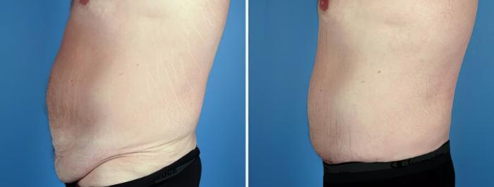 Tummy Tuck Before & After Case 17508