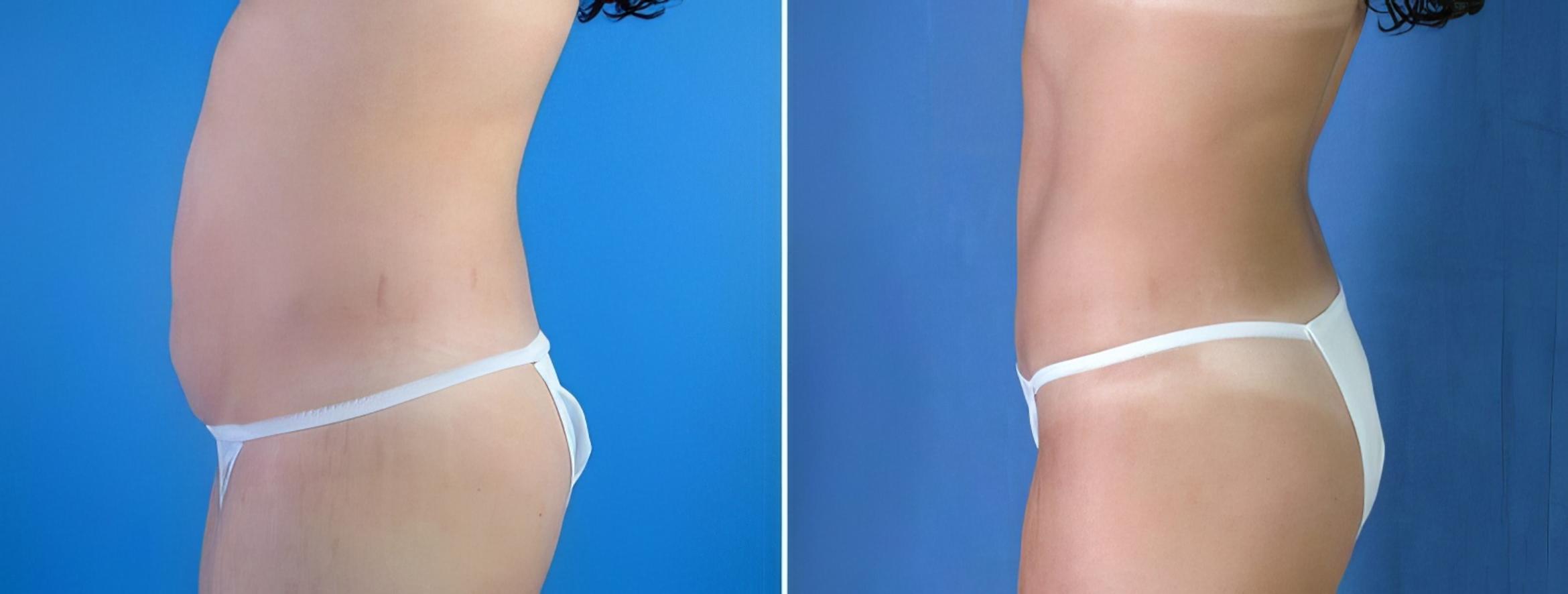 Tummy Tuck Before & After Case 17874