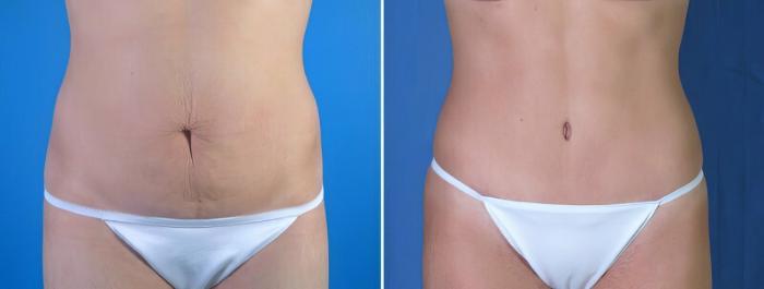 Tummy Tuck Before & After Case 17874