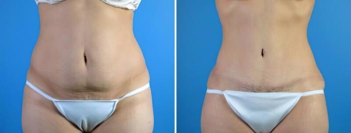 Tummy Tuck Before & After Case 17918