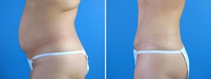 Tummy Tuck Before & After Case 17918