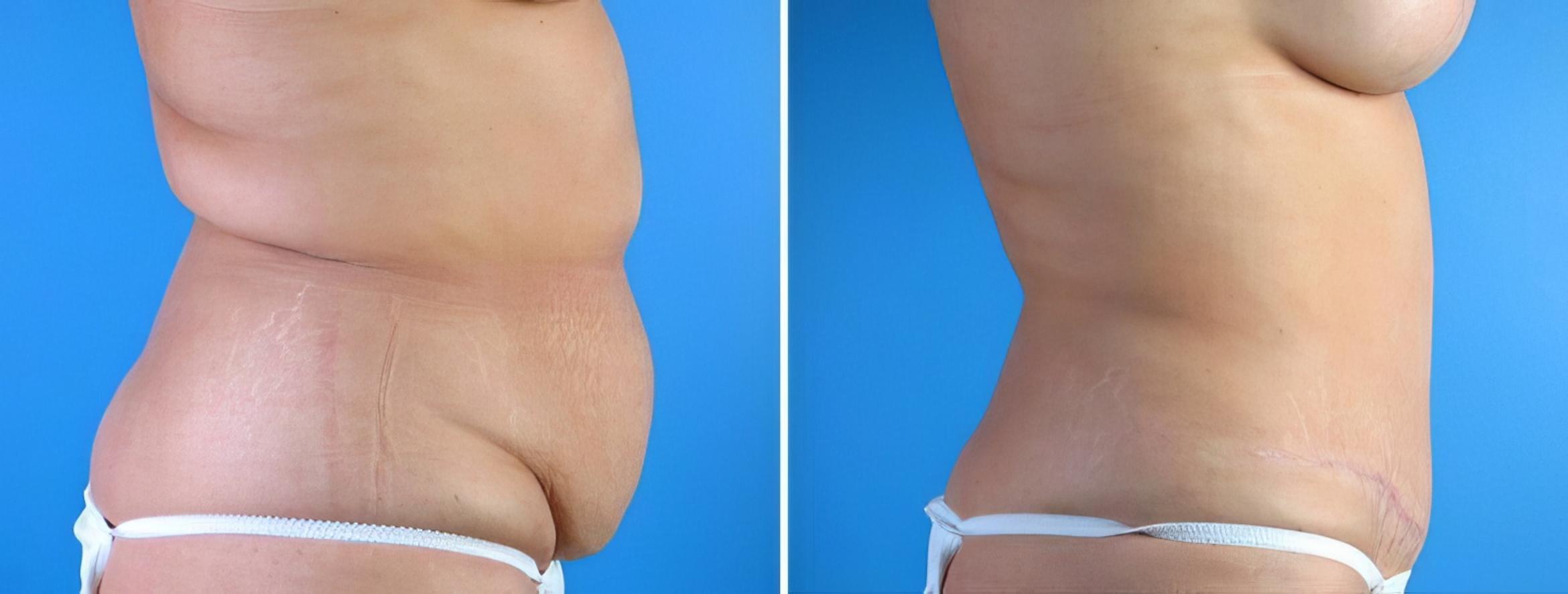 Tummy Tuck Before & After Case 17921