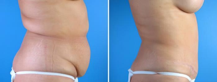 Tummy Tuck Before & After Case 17921
