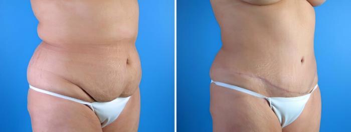 Tummy Tuck Before & After Case 17921