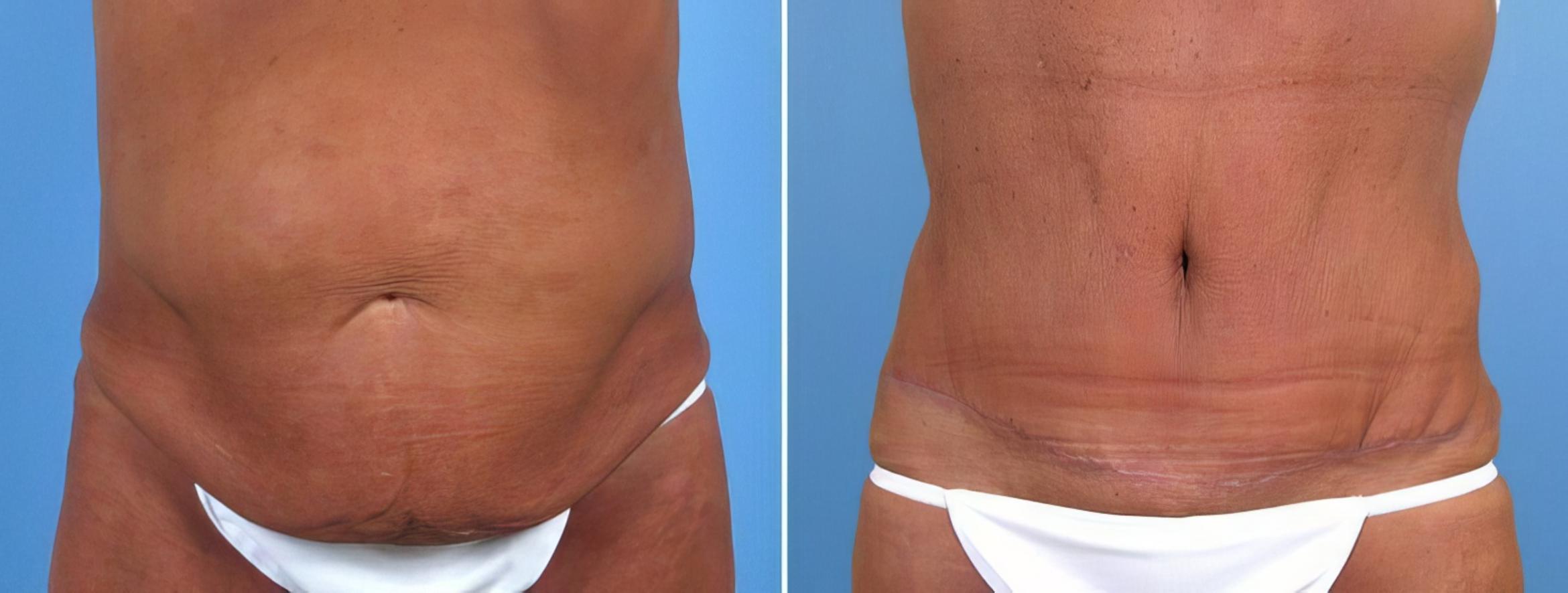 Tummy Tuck Before & After Case 18105