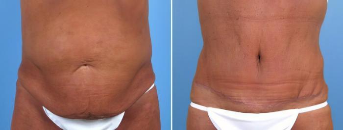 Tummy Tuck Before & After Case 18105