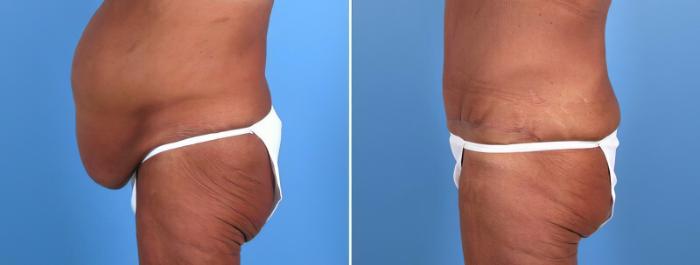 Tummy Tuck Before & After Case 18105