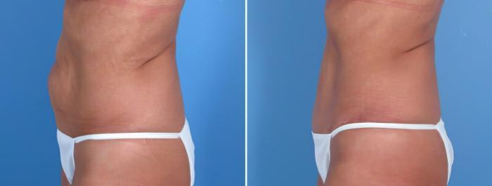 Tummy Tuck Before & After Case 18111