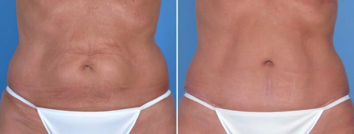 Tummy Tuck Before & After Case 18111