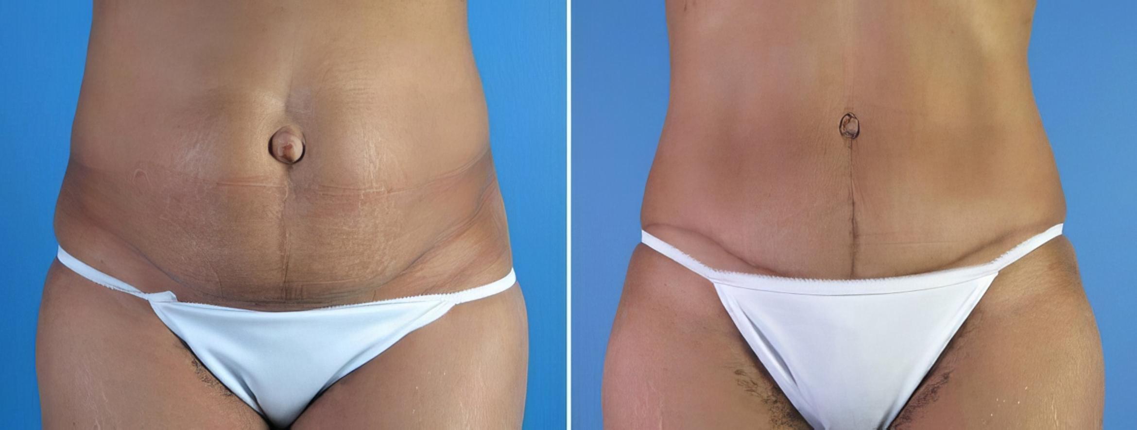 Tummy Tuck Before & After Case 18117