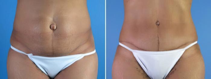 Tummy Tuck Before & After Case 18117