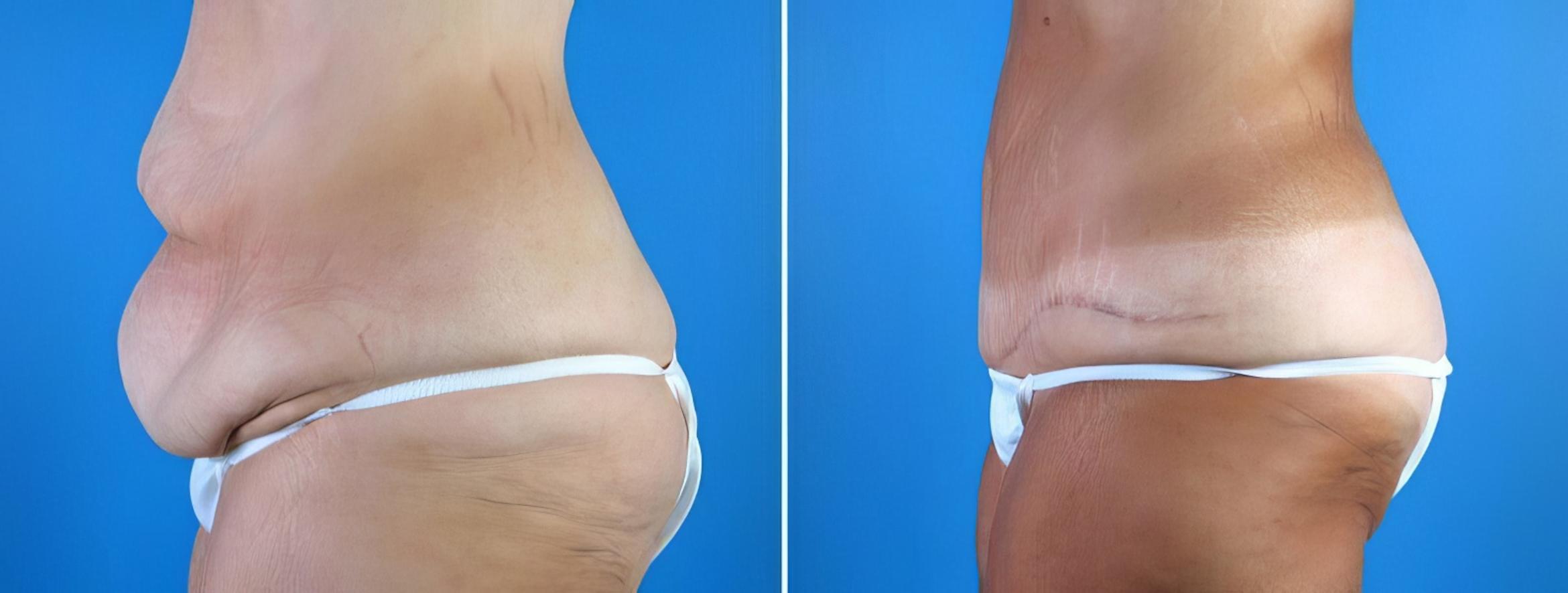 Tummy Tuck Before & After Case 18120