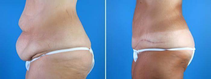 Tummy Tuck Before & After Case 18120