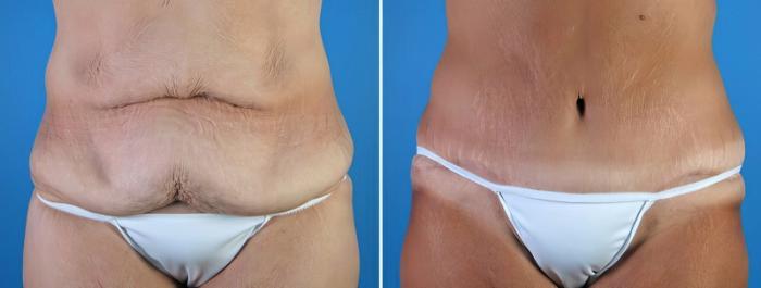 Tummy Tuck Before & After Case 18120