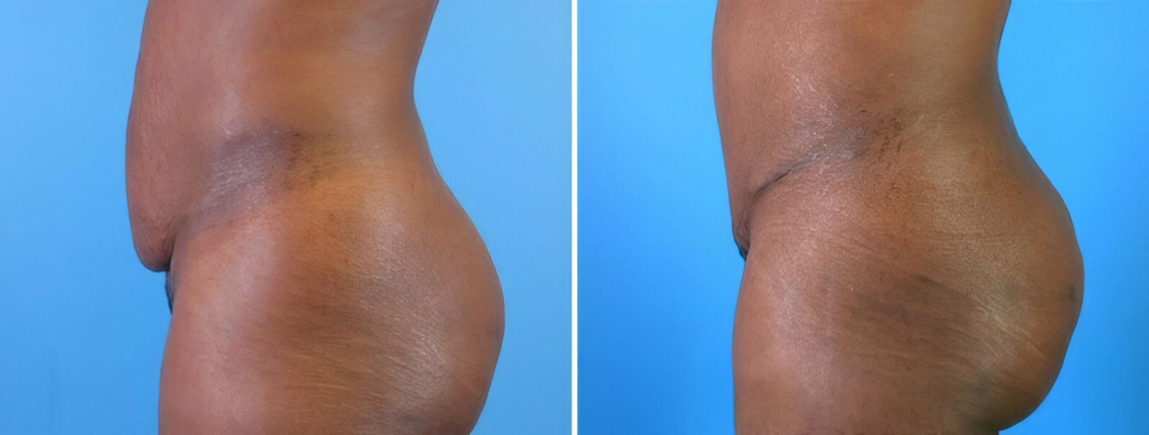 Tummy Tuck Before & After Case 18123