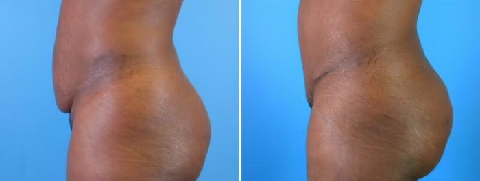 Tummy Tuck Before & After Case 18123