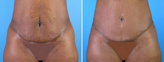 Tummy Tuck Before & After Case 18123