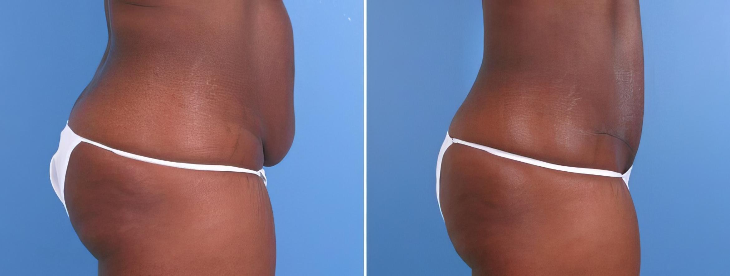 Tummy Tuck Before & After Case 18126