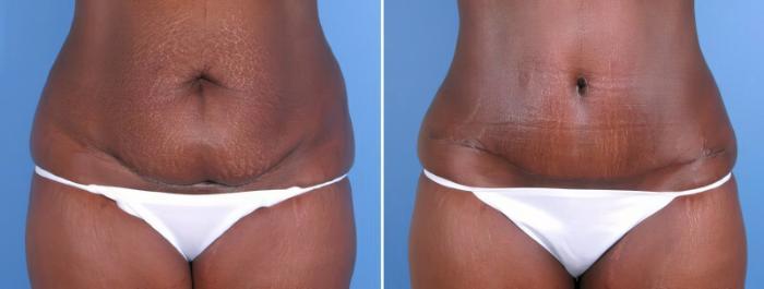 Tummy Tuck Before & After Case 18126