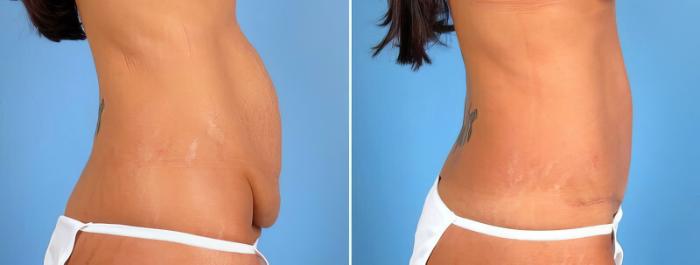 Tummy Tuck Before & After Case 18129