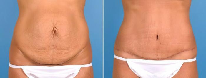 Tummy Tuck Before & After Case 18129