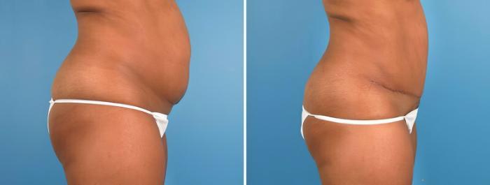 Tummy Tuck Before & After Case 18138