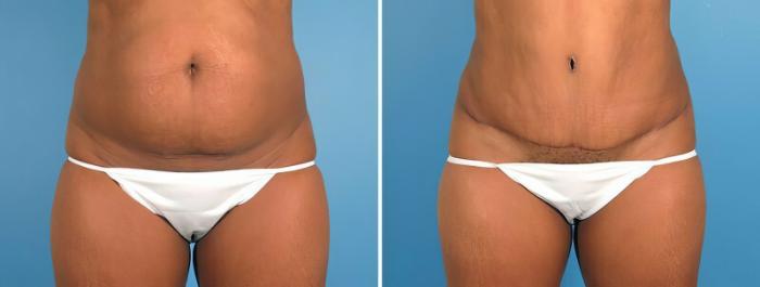 Tummy Tuck Before & After Case 18138