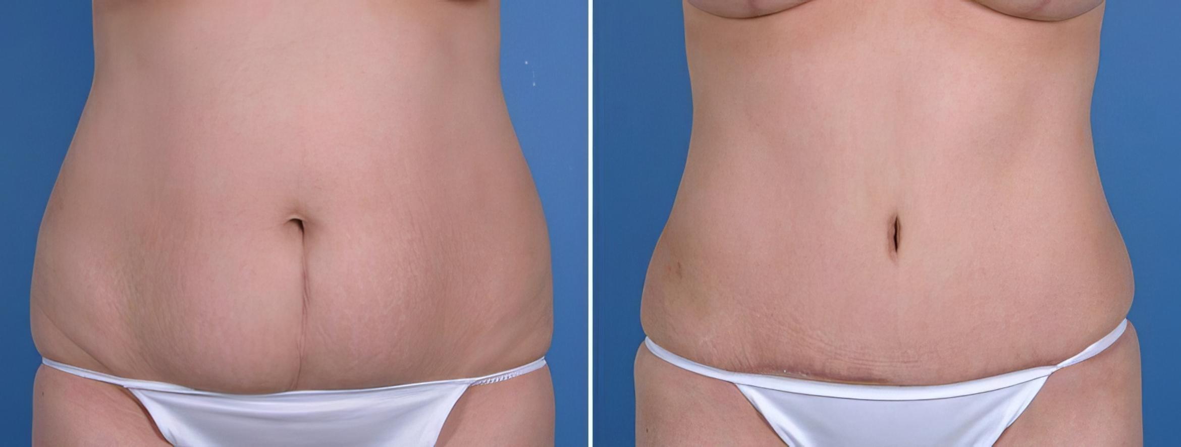 Tummy Tuck Before & After Case 18783
