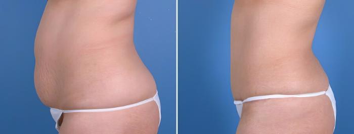 Tummy Tuck Before & After Case 18783