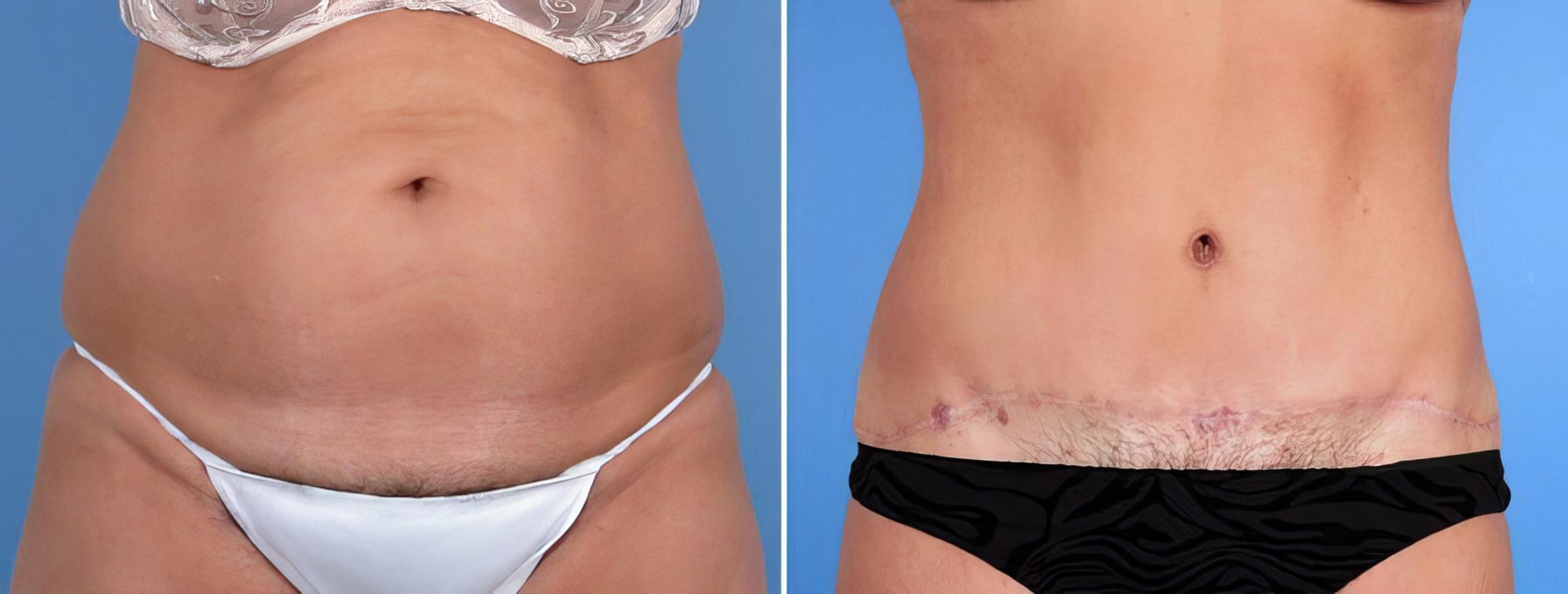 Tummy Tuck Before & After Case 18786