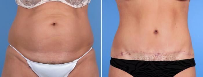 Tummy Tuck Before & After Case 18786