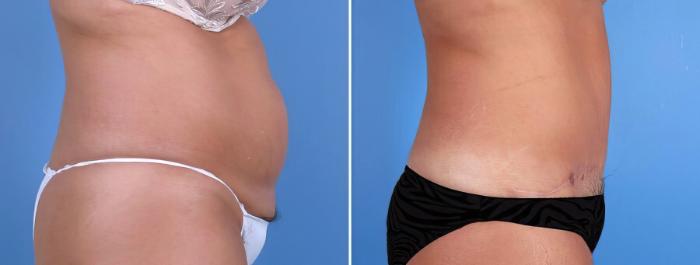 Tummy Tuck Before & After Case 18786